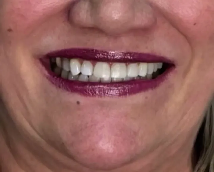 Facetas